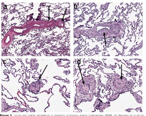 Pulmonary Artery Histology