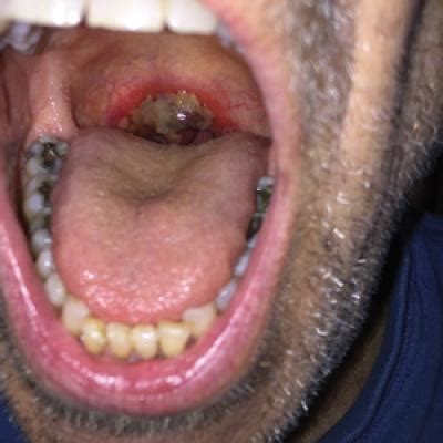 Friable Erythema and Erosions on the Mouth | MDedge Dermatology