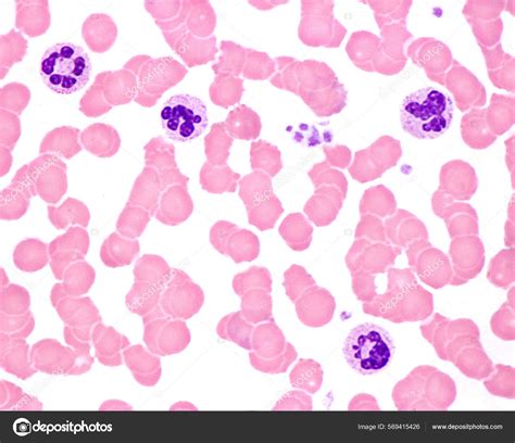 Human Blood Smear Leukocytosis Acute Infection Neutrophil Leukocytes Exhibit Nuclear Stock Photo ...