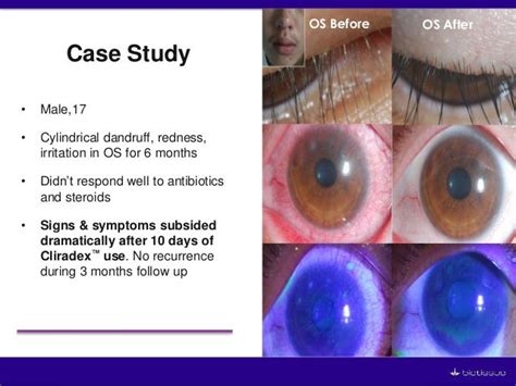 New Technologies for Successfully Managing Ocular Surface Inflammat…