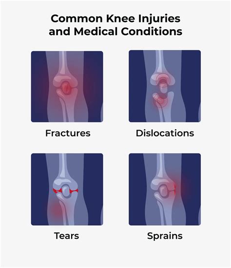 Workers' Comp Knee Injury Settlement - Matt Fendon Law Group