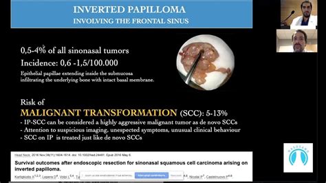 Surgical management of inverted papilloma involving the frontal sinus ...