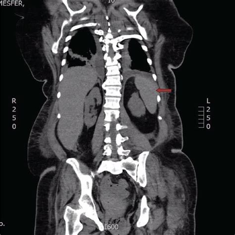 CT scan of the abdomen with IV contrast showing a normal spleen (red ...