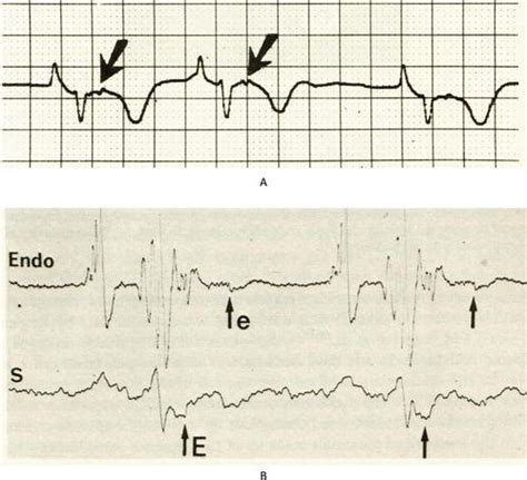 Epsilon Waves: The Gate to Understand Arrhythmogenic Right Ventricular Dysplasia | IntechOpen