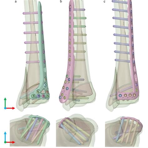 Three different type distal tibia plates were implanted on a distal... | Download Scientific Diagram