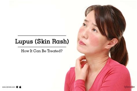 Lupus (Skin Rash) - How It Can Be Treated? - By Dr. Sandesh Gupta | Lybrate