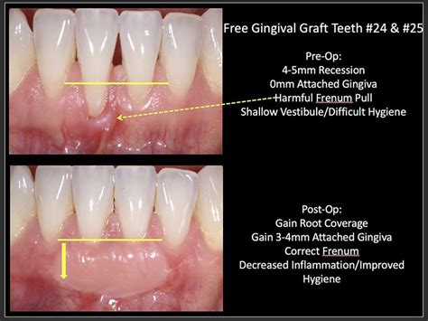 Does Health Insurance Cover Gum Graft - insurance cover mental health