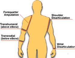 Upper Limb Amputations | Capital Health | Physical therapist assistant, Prosthetics, Limb