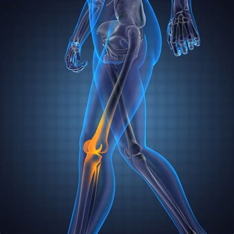 Treating Chronic Knee Pain | Louisville Orthopedic Surgeon