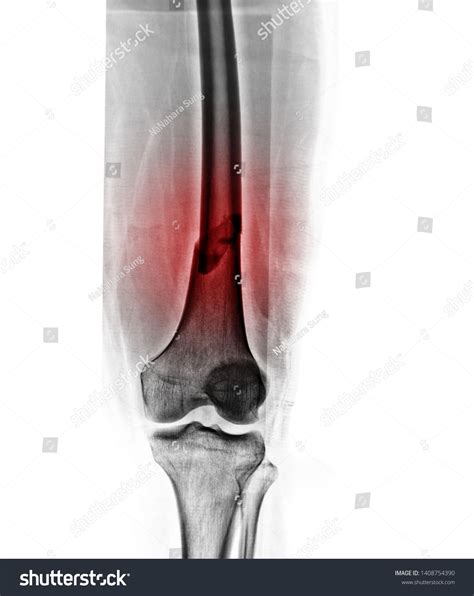 Film Xray Knee Joints Show Fracture Stock Photo 1408754390 | Shutterstock