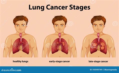 Informative Illustration of Lung Cancer Stages Stock Vector ...