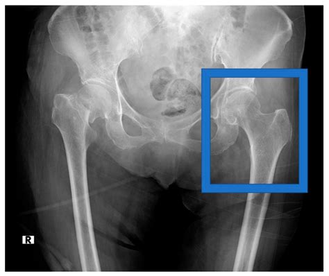 Biomolecules | Free Full-Text | Deep Learning for Osteoporosis ...