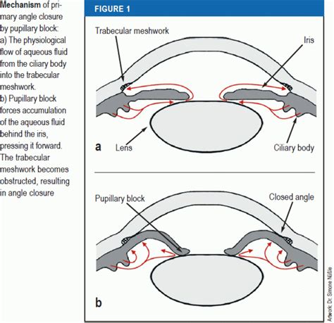 Closed Angle Glaucoma Vs Open Angle