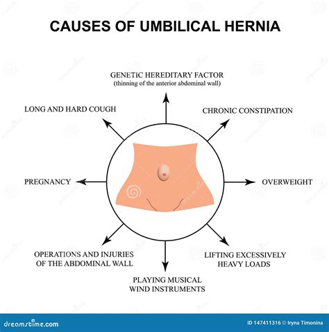 Causes Of Umbilical Hernia. Infographics. Vector Illustration On ...