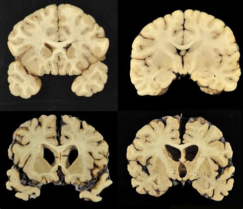 A breakthrough on CTE - The Blade