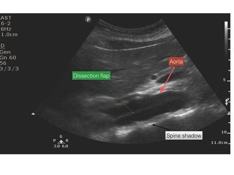 Aortic Dissection (2014) | Emory School of Medicine