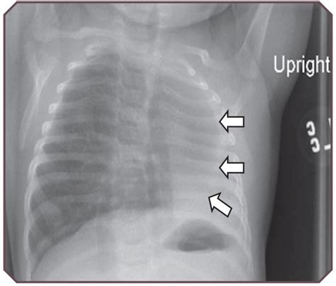 Pulmonary Hypoplasia | Obgyn Key