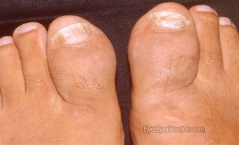 Symptoms causes treatment of disease: Dactylitis – Symptoms, Causes, Treatment, Pictures