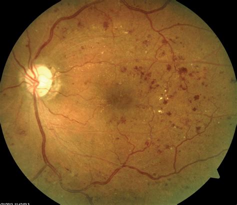 My Patient Has Diabetic Retinopathy...Now What?