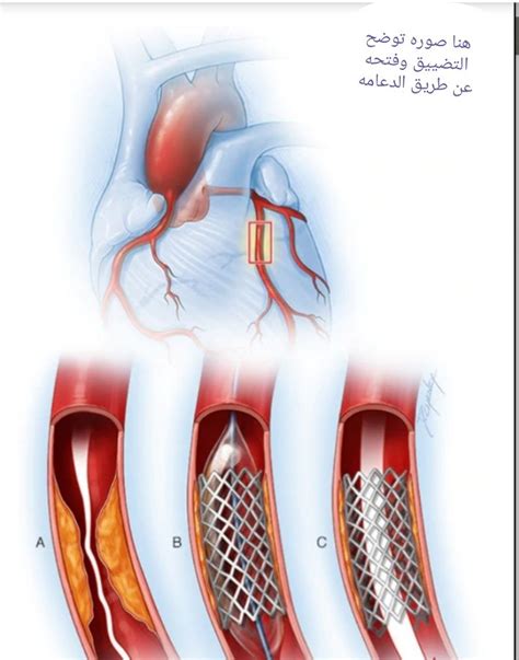 قسطرة القلب هي إجراء يستخدم لتشخيص وعلاج بعض أمراض القلب والأوعية ...