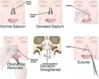 Septoplasty Cleveland Nasal Sinus & Sleep Center * ENT Sinus & Sleep ...