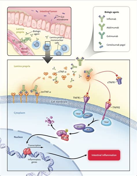 Tumor Necrosis Factor Inhibitors for Inflammatory Bowel Disease | NEJM