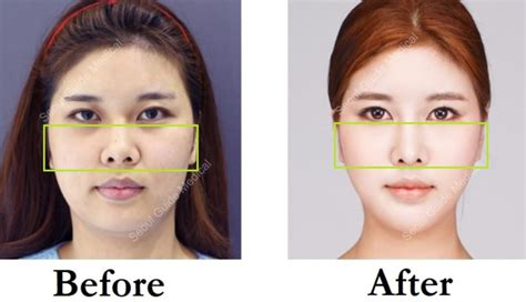 Your Guide to Getting Zygoma Reduction in Korea - Seoul Guide Medical