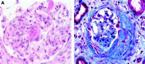 ANCA associated glomerulonephritis in a patient with mixed connective tissue disease | Annals of ...