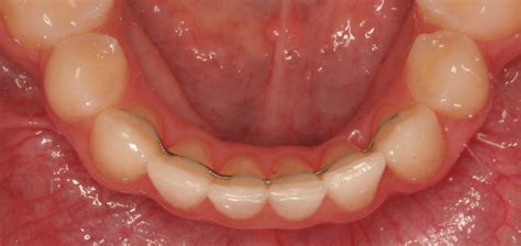 Retainer Instructions - Comella Orthodontics | Rochester Victor NY