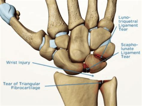 Triangular FibroCartilage Complex (TFCC) Injury - Teton Hand Surgery