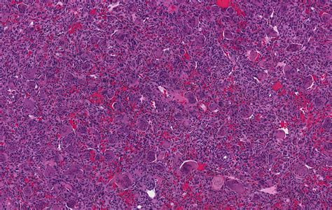 Pathology Outlines - Central giant cell granuloma