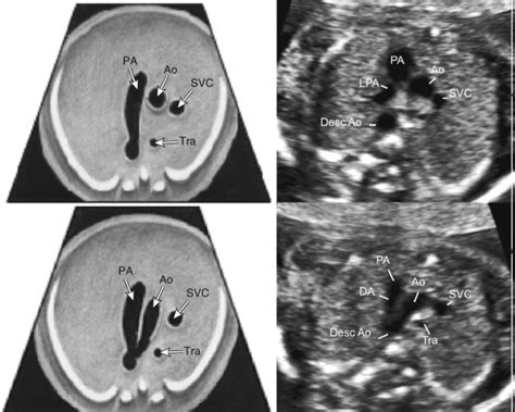 Sonographic Evaluation of the Fetal Heart | Radiology Key