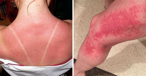 5 Signs Your Sunburn Is Actually Sun Poisoning