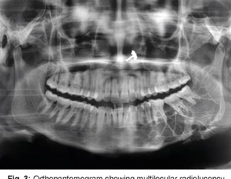 Figure 3 from Odontogenic Myxoma of the Mandible : A Rare Case Report | Semantic Scholar