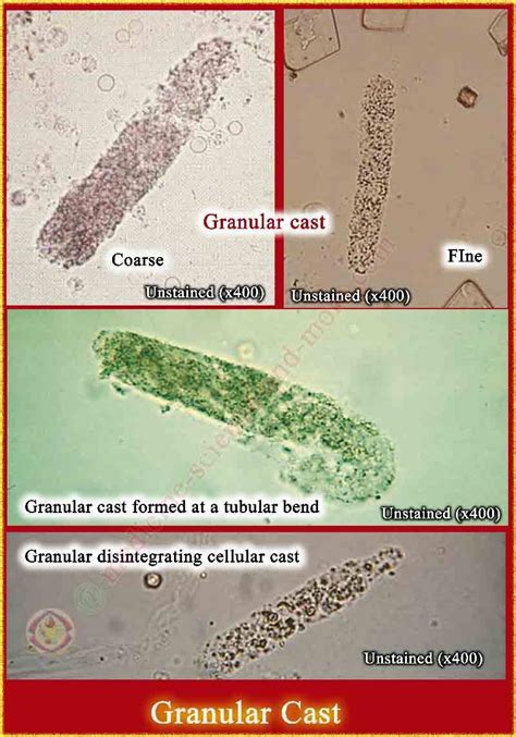 Granular Cast In Urine