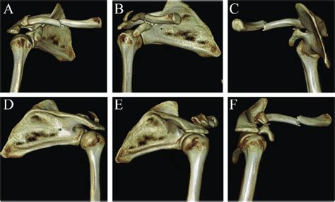 An displaced mid-shaft clavicle fracture and ipsilateral distal end ...