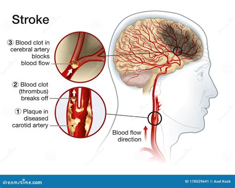 Brain Stroke, Medically Accurate Illustration Stock Vector - Illustration of biology, stroke ...