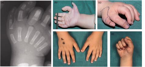 Triphalangeal thumb: clinical features and treatment - Steven E. R. Hovius, Jacob W. P. Potuijt ...