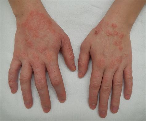 Dermatitis - Wikiwand