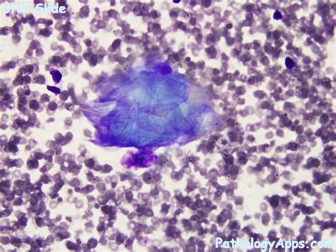 teratoma ovary cytology