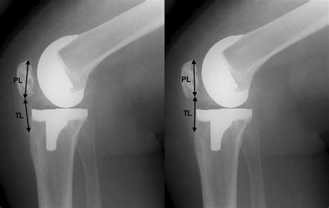 Knee Replacement Xray