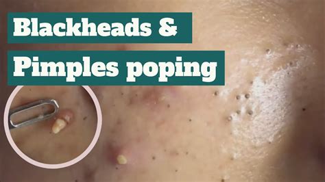 Pimple Popping 2025 Blackheads - Tommy Gretchen