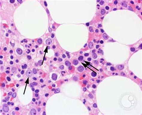 Myeloid Neoplasms. Myelodysplastic Syndrome: Refractory Ctyopenia with ...