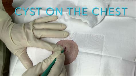CYST ON THE CHEST AT COASTAL DERMATOLOGY AND MEDSPA - YouTube