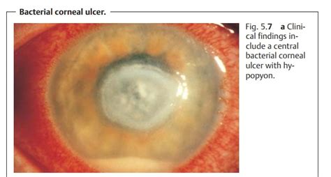 Microbial Keratitis