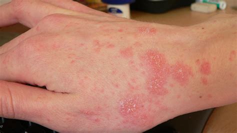 Scabies Bites: Pictures, Symptoms, and Treatments