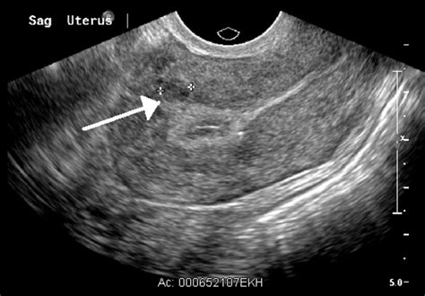 Intramural Fibroid Ultrasound