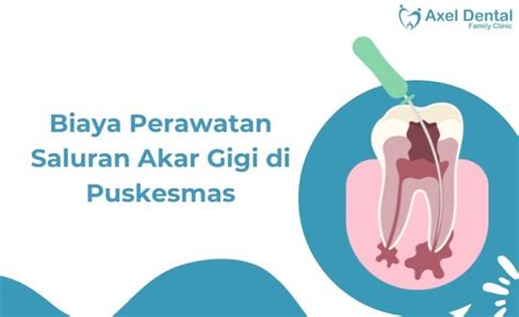 Biaya Perawatan Saluran Akar Gigi di Puskesmas Terdekat