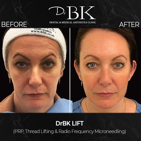 Thread Face Lifting | Non-Surgical Thread Lift | DrBK London