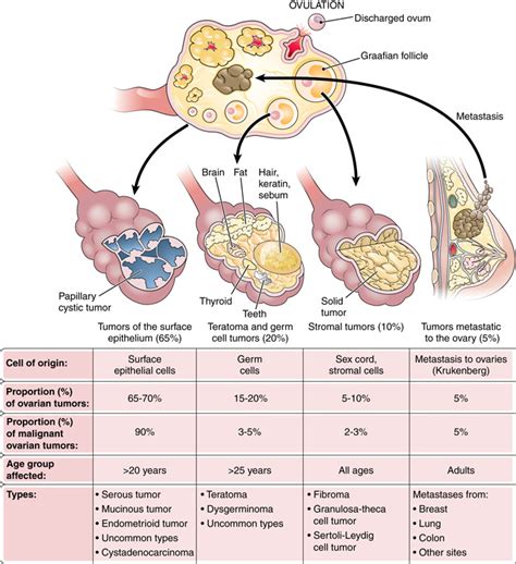 Ovarian Cancer | Diseases & Conditions | 5MinuteConsult